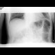 Pneumatosis of the colon: X-ray - Plain radiograph